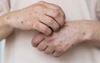 “Campak Melanda Jabar, Warga Diminta Waspada saat Mudik”